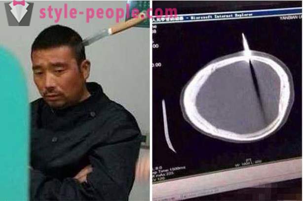 Isang Chinese tao na may isang kutsilyo sa kanyang ulo siya nagpunta sa doktor