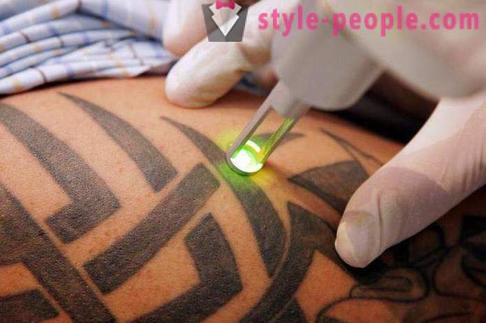 Laser tattoo pag-alis. Sinuri ang