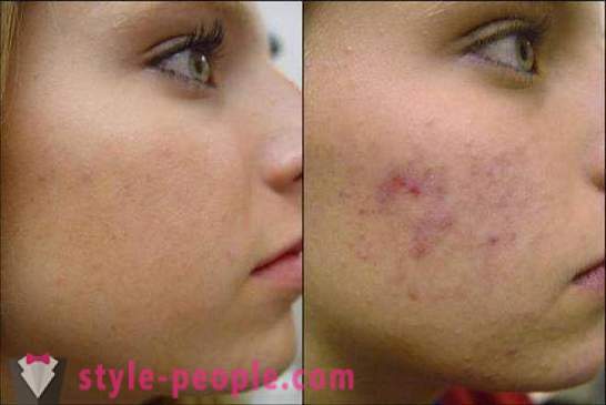 Namin tinatrato ang acne scars